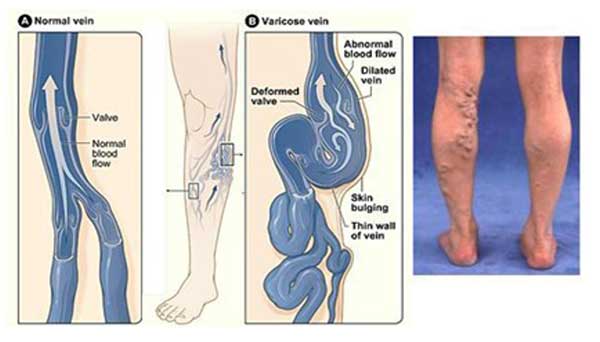 Varicose Veins Cairns Vascular Clinic