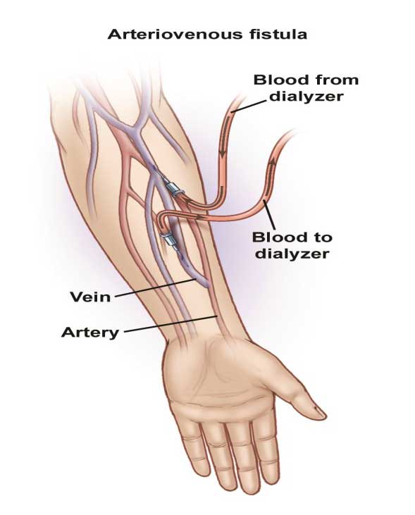 arterio-venous-fistula-avf-creation-for-haemodialysis-cairns